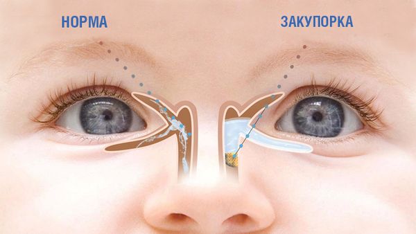 Закупорка носослёзного протока