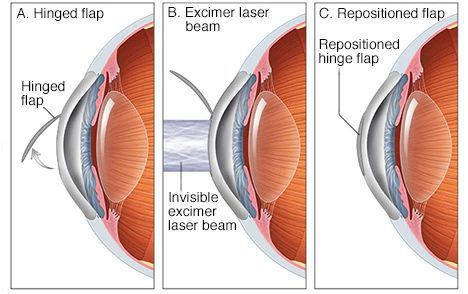 Лазерная коррекция зрения LASIK