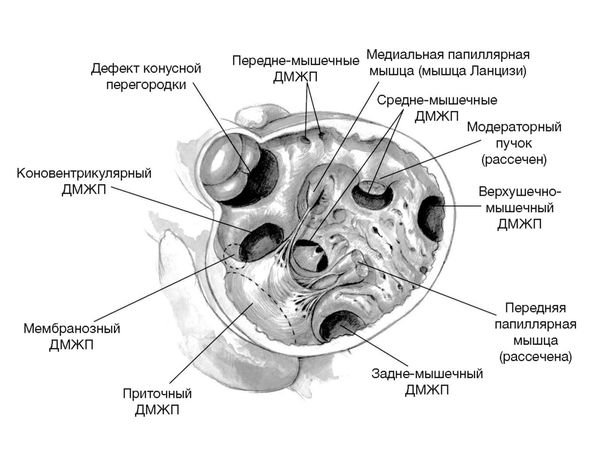 Коррекция врожденного порока сердца