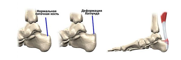 Болезнь Хаглунда — Шинца