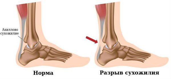 Разрыв ахиллова сухожилия