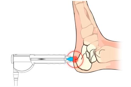 Ударно-волновая терапия