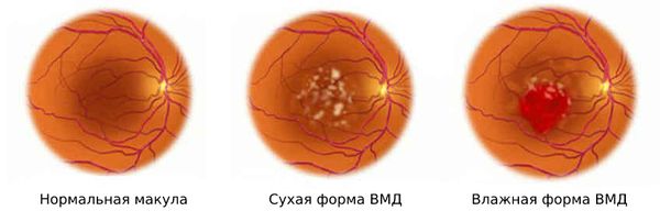 Формы ВМД Формы ВМД