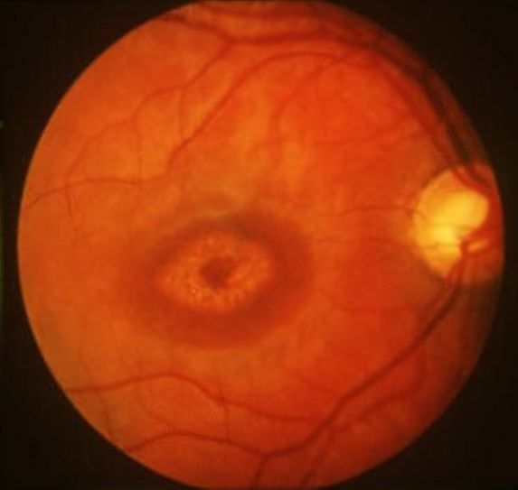 Макулопатия «бычьего глаза» [28]