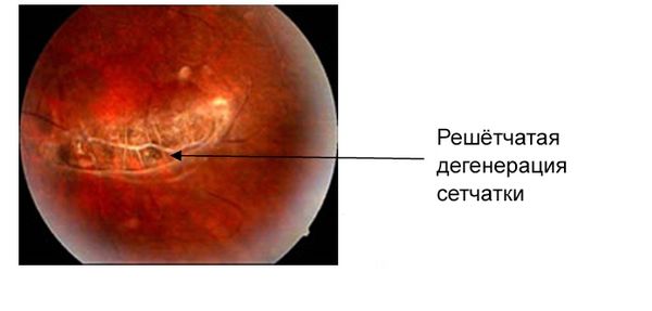 Решётчатая дистрофия [29]