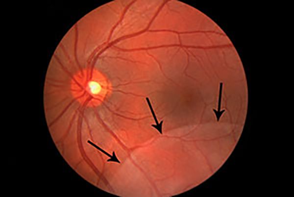 Ретиношизис [32]