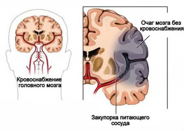 Ишемия участка головного мозга
