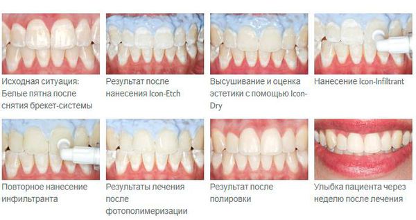 Лечение по технологии Icon [17]