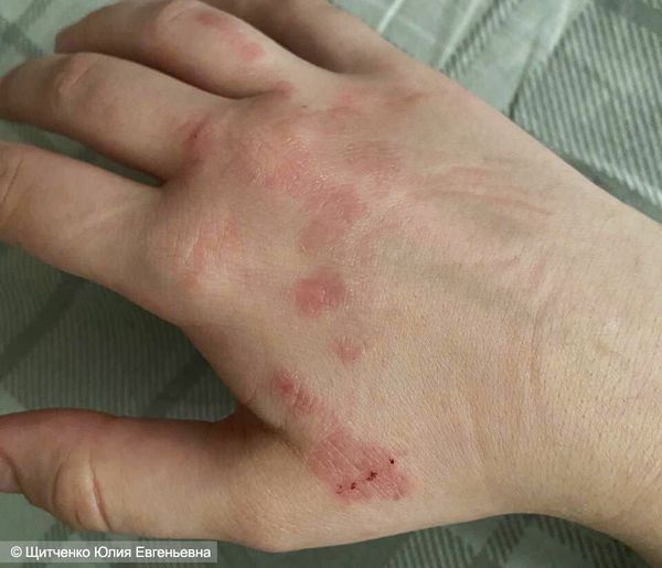 Аллергический контактный дерматит после использования бытовой химии
