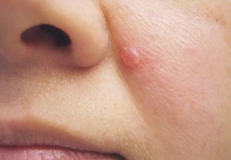 Базалиома [33]