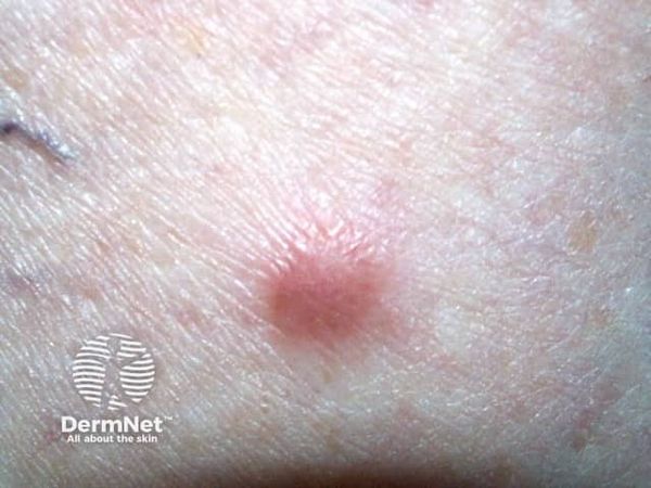 Дерматофиброма [30]