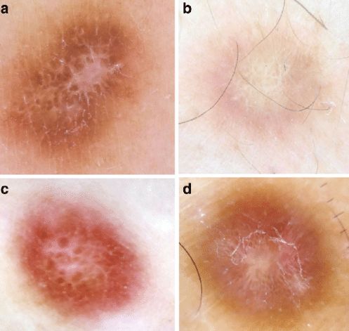 Дерматофиброма под дерматоскопом [32]