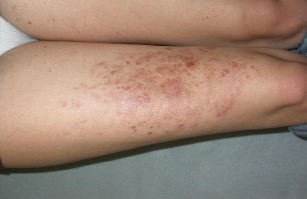 Множественная дерматофиброма [31]