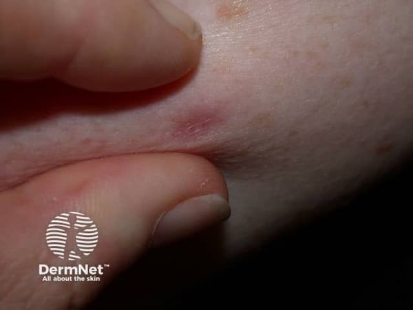 Образование ямки [30]