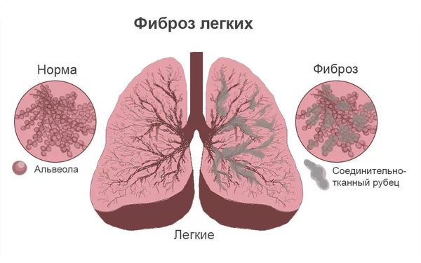 Фиброз лёгких