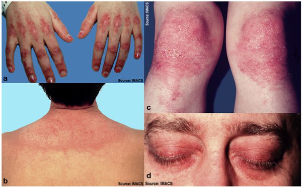 Поражение кожи при дерматомиозите [16]