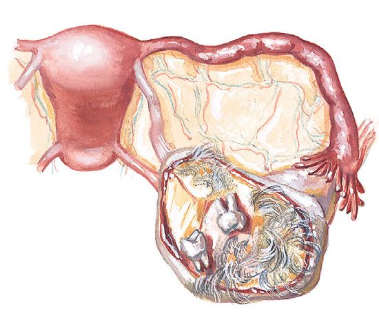 Дермоидная киста яичника и её содержимое