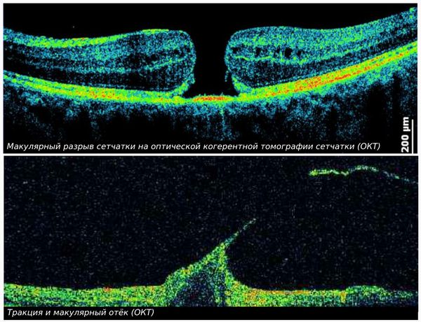 Макулярные отёк и разрыв сетчатки