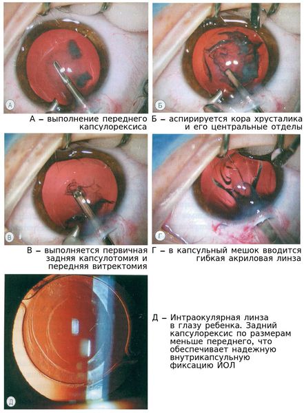 Факоаспирация катаракты с имплантацией интраокулярной линзы у трехлетнего ребёнка с ламеллярной катарактой