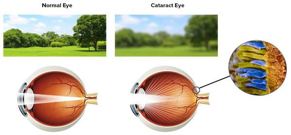 Изменение зрения при катаракте
