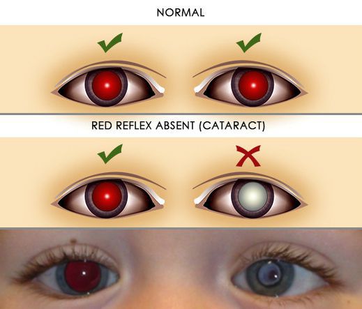 Признак катаракты при проведении прямой офтальмоскопии