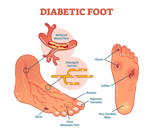 Синдром диабетической стопы