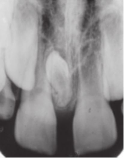 Диастема на рентгенограмме. Между резцами лишний зачаток [19]
