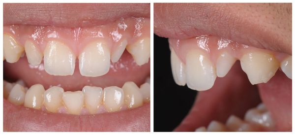 Микродентия [18]