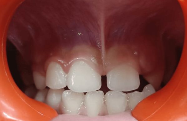 Низкое прикрепление уздечки верхней губы к десне [17]