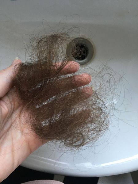 Аномальное количество выпавших волос