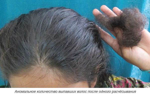 Патологическое количество выпавших волос после одного расчёсывания