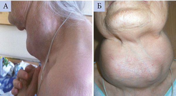 Гигантский зоб у пациентки [27]