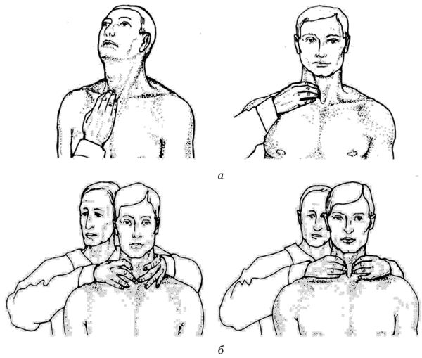 Методы пальпации щитовидной железы: а — ощупывание перешейка и правой боковой доли; б — ощупывание перешейка и боковых долей Методы пальпации щитовидной железы: а — ощупывание перешейка и правой боковой доли; б — ощупывание перешейка и боковых долей