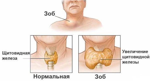 Нормальная и увеличенная щитовидная железа