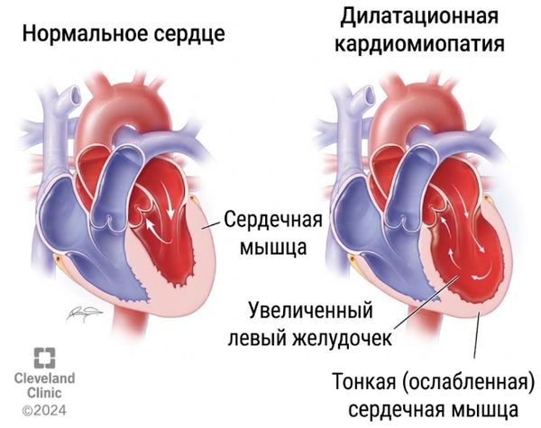 Дилатационная кардиомиопатия Дилатационная кардиомиопатия