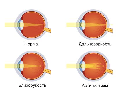 Аномалии рефракции глаза