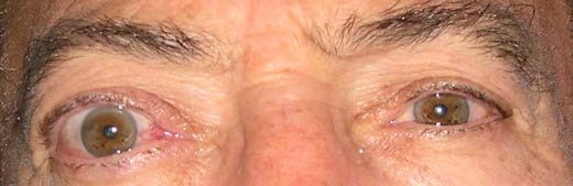 Эндокринная офтальмопатия [25]