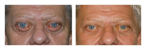 Глаза до и после декомпрессии орбиты при экзофтальме [29]