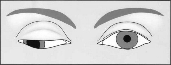 Глазодвигательный паралич