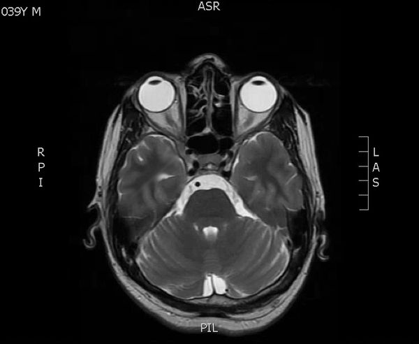 МРТ при бинокулярной диплопии [26]