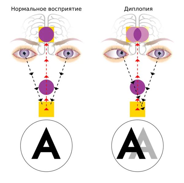 Нормальное зрение и диплопия
