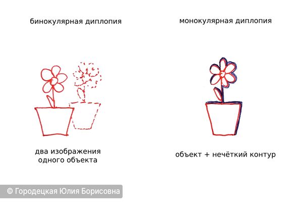 Различие монокулярной и бинокулярной диплопии