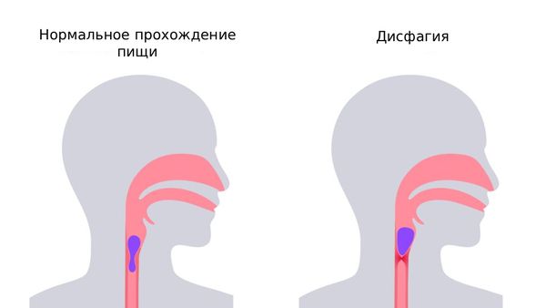 Дисфагия