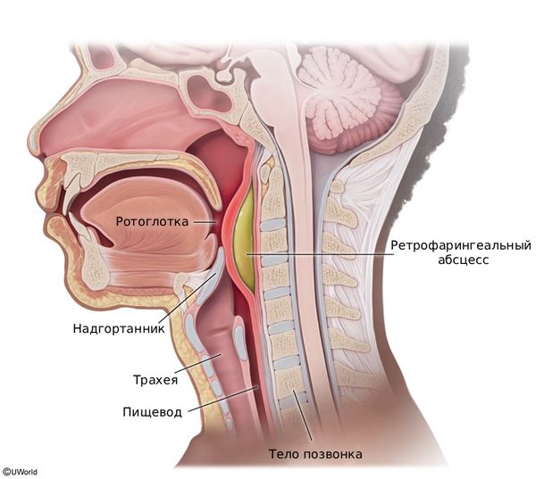 Ретрофарингеальный абсцесс