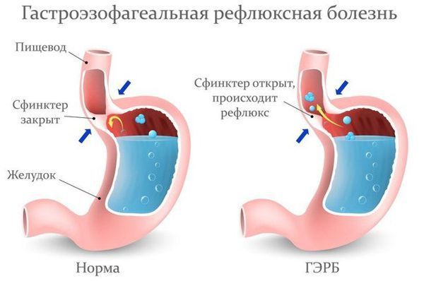 Заброс желудочного сока в пищевод