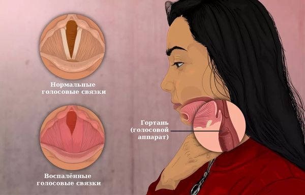 Дисфония из-за воспаления голосовых связок [12]