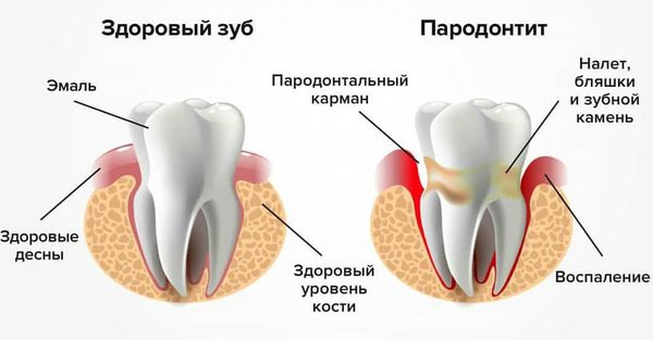 parodontit s