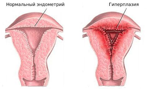 normalnyy endometriy i giperplaziya s
