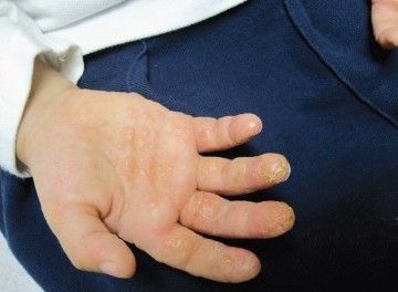 ДЭ с пузырьками на ладонях и шелушащимися пятнами с корками и трещинами на пальцах [3]