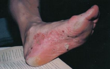 Дисгидротическая экзема кожи стоп [21] (чтобы посмотреть изображение, нажмите на него)